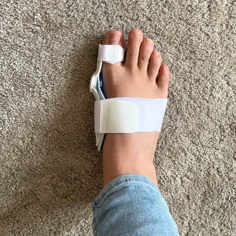 Hallux valgus stödskena ovanifrån som sitter på en kvinnas högra fot